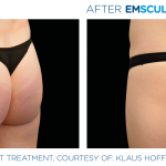 EmSculpt NEO fat burning and muscle building treatments Before and After at Artemedica in Santa Rosa