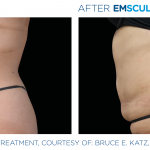 Before and after woman's EmSculpt Neo treatment to reduce fat and encourage muscle growth