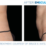 EmSculpt NEO fat burning and muscle building treatments Before and After at Artemedica in Santa Rosa