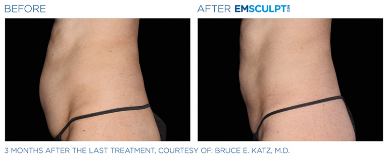 EmSculpt NEO fat burning and muscle building treatments Before and After at Artemedica in Santa Rosa