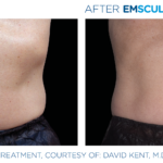 EmSculpt NEO fat burning and muscle building treatments Before and After at Artemedica in Santa Rosa