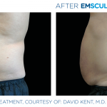 EmSculpt NEO fat burning and muscle building treatments Before and After at Artemedica in Santa Rosa