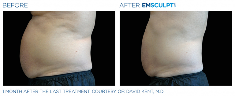 EmSculpt NEO fat burning and muscle building treatments Before and After at Artemedica in Santa Rosa