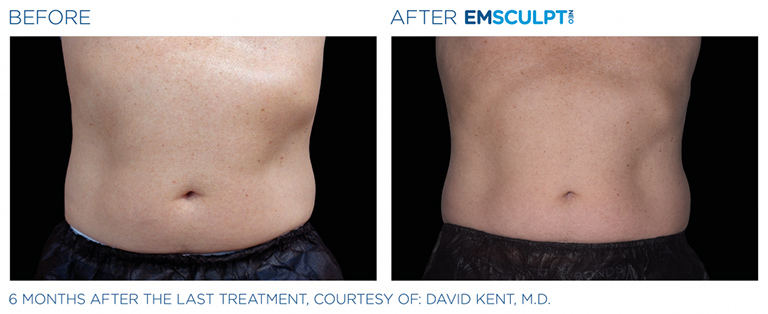 EmSculpt NEO fat burning and muscle building treatments Before and After at Artemedica in Santa Rosa