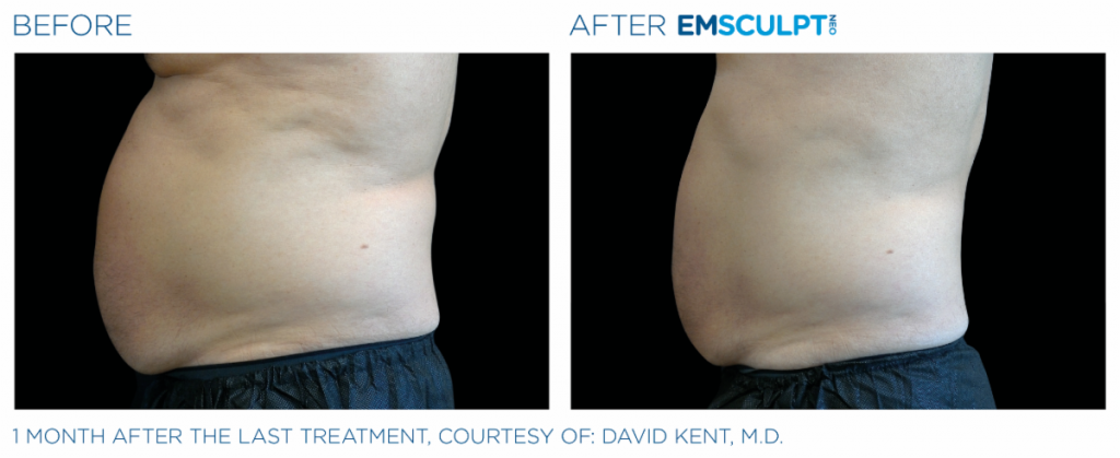 EmSculpt NEO fat burning and muscle building treatments Before and After at Artemedica in Santa Rosa