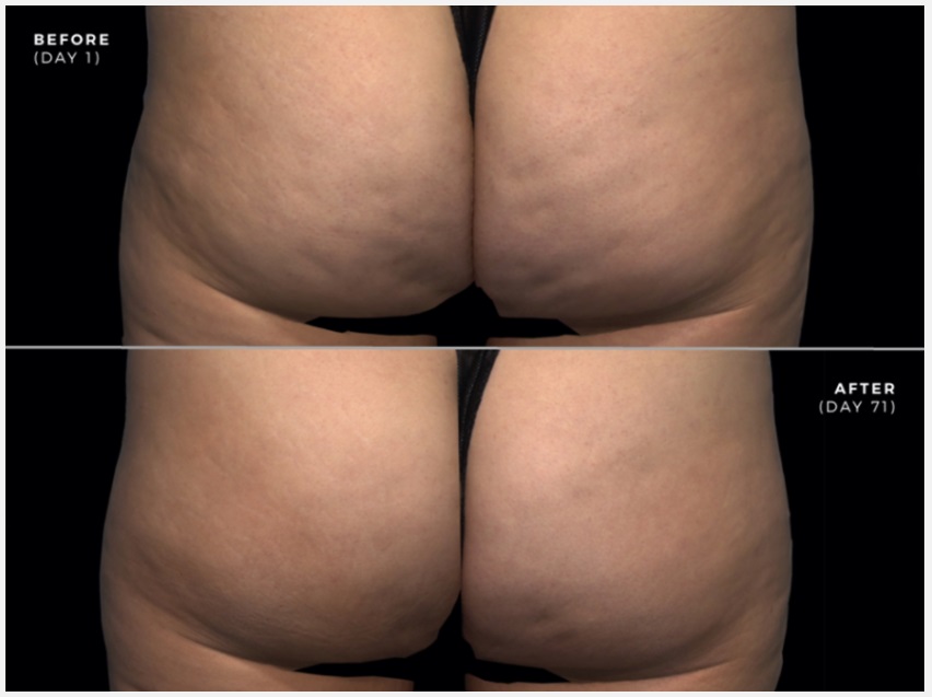 Before and after woman's QWO injection treatment to effectively treat moderate to severe cellulite in a woman’s thigh and butt