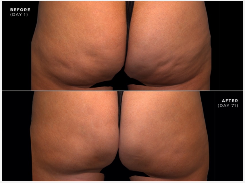 before qwo cellulite treatment
