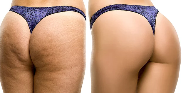 Female buttocks before and after QWO injectable Cellulite treatments at Artemedica