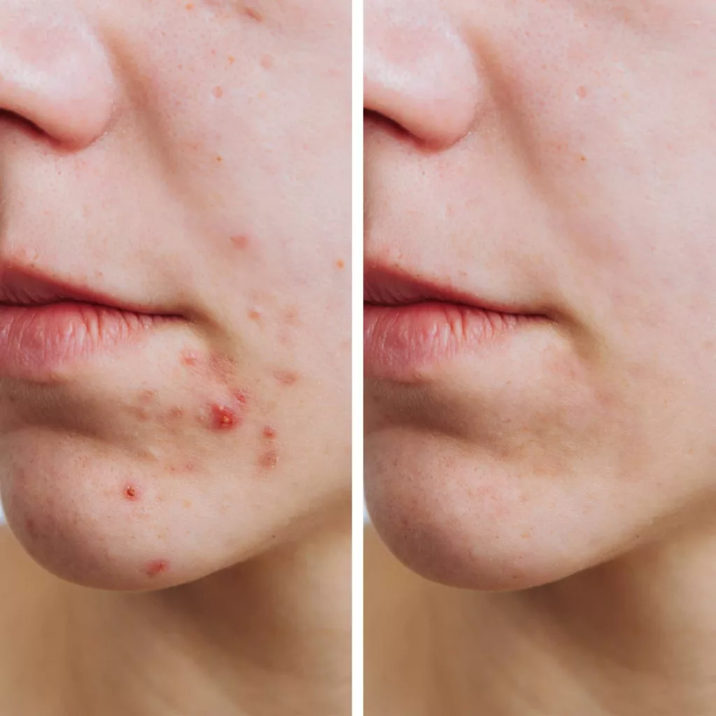 before and after diamondglow facial