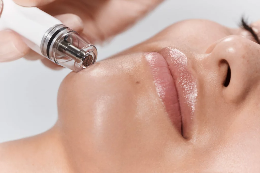 female patient receiving diamondglow facial dermabrasion