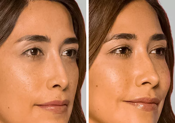 before and after restylane contour fillers to enhance cheek contour