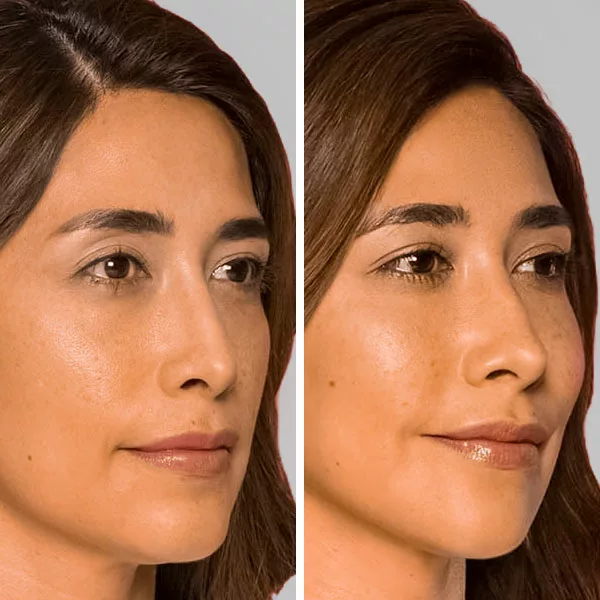 before and after restylane contour fillers to enhance cheek contour