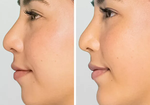 before and after restylane defyne fillers to enhance chin and jawline profile