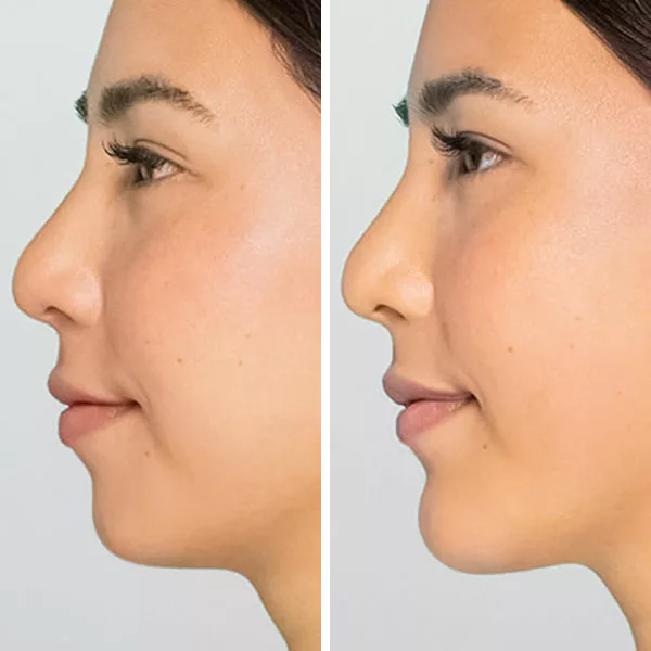 before and after restylane defyne fillers to enhance chin and jawline profile