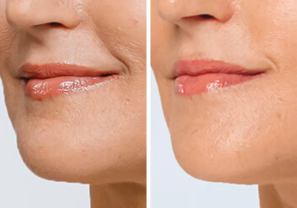 before and after restylane lyft fillers to diminish wrinkles and fine lines