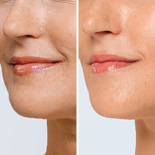 before and after restylane lyft fillers to diminish wrinkles and fine lines