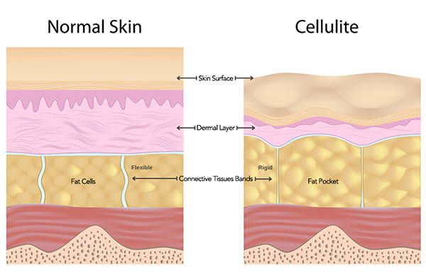 infographic showing how cellulite affects skin texture