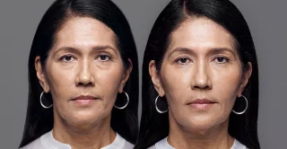 RHA fillers before and after treatment for dynamic wrinkles