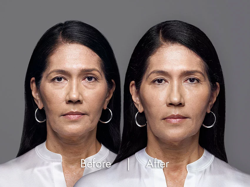 RHA fillers before and after treatment for dynamic wrinkles
