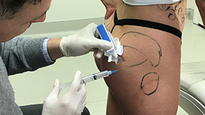 Artemedica client receiving sculptra injections