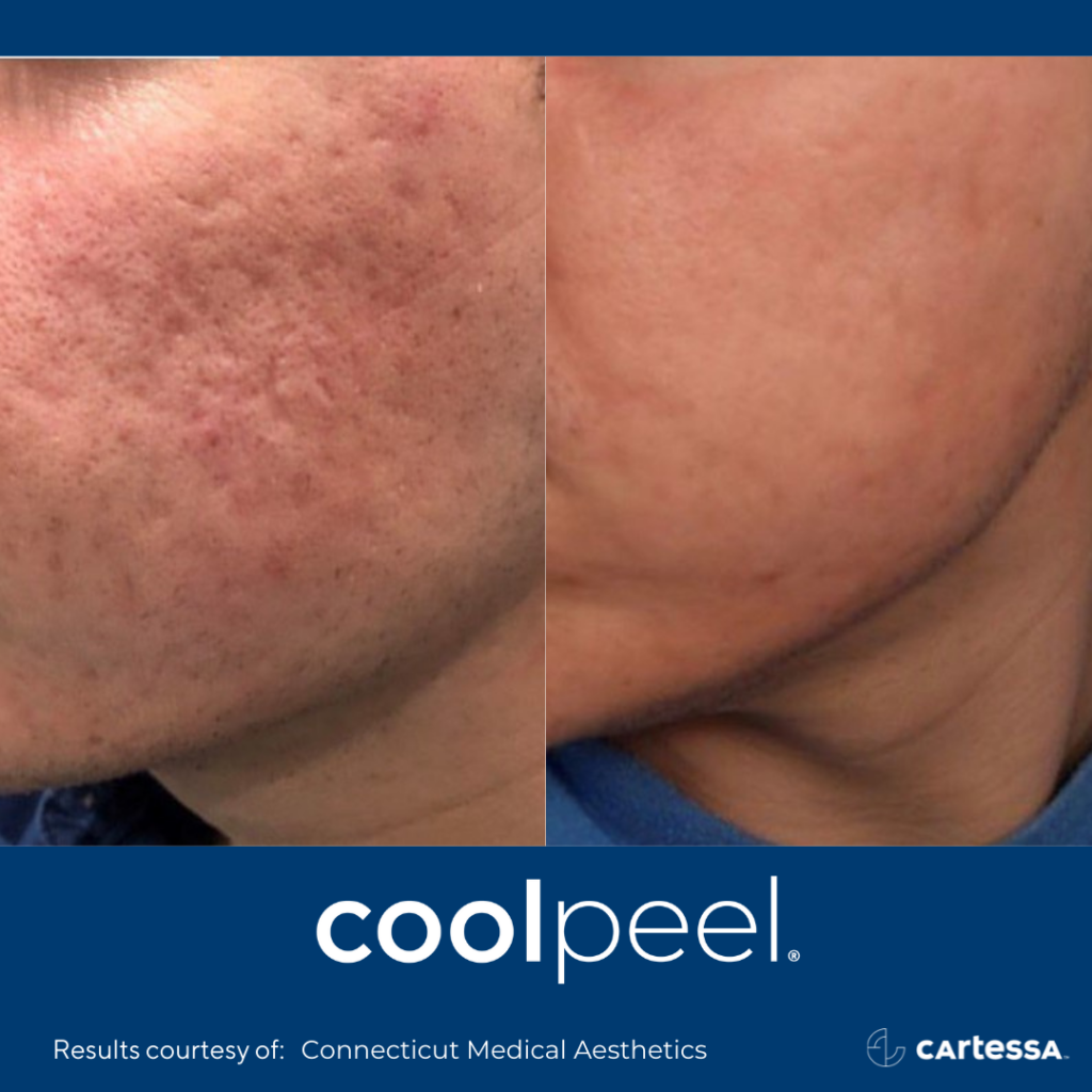 before and after CoolPeel laser treatment showing reduced texturing and wrinkles on a woman's face
