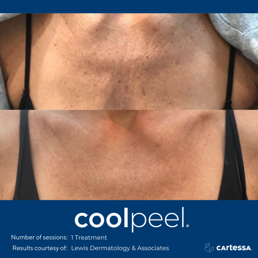 before and after CoolPeel treatment showing reduced wrinkles and texturing around a woman's collar area and shoulders