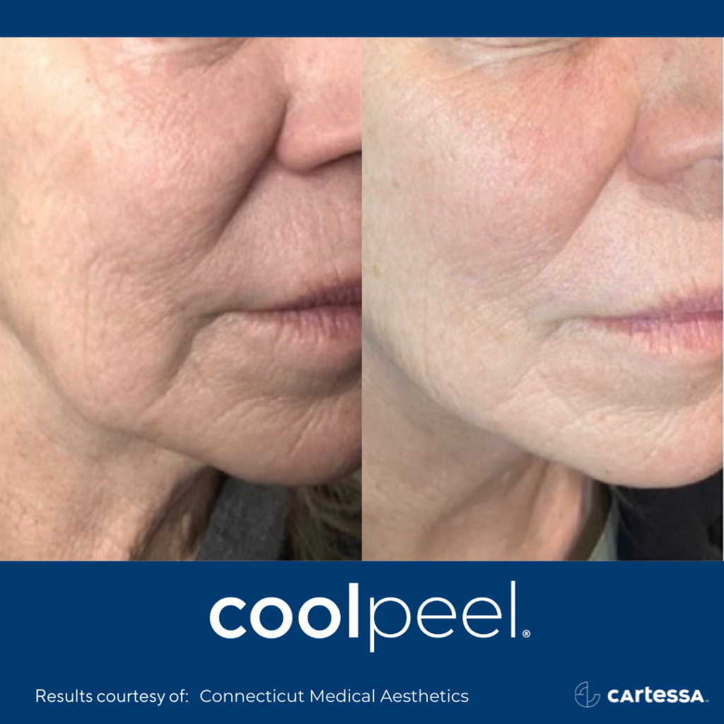before and after CoolPeel laser treatment showing reduced wrinkles and texturing on a woman's face