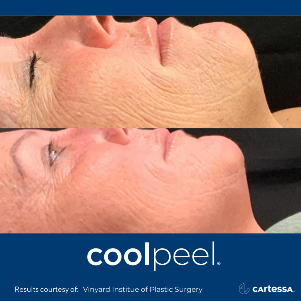 before and after CoolPeel Laser Resurfacing showing reduced wrinkles and texturing on a woman's face