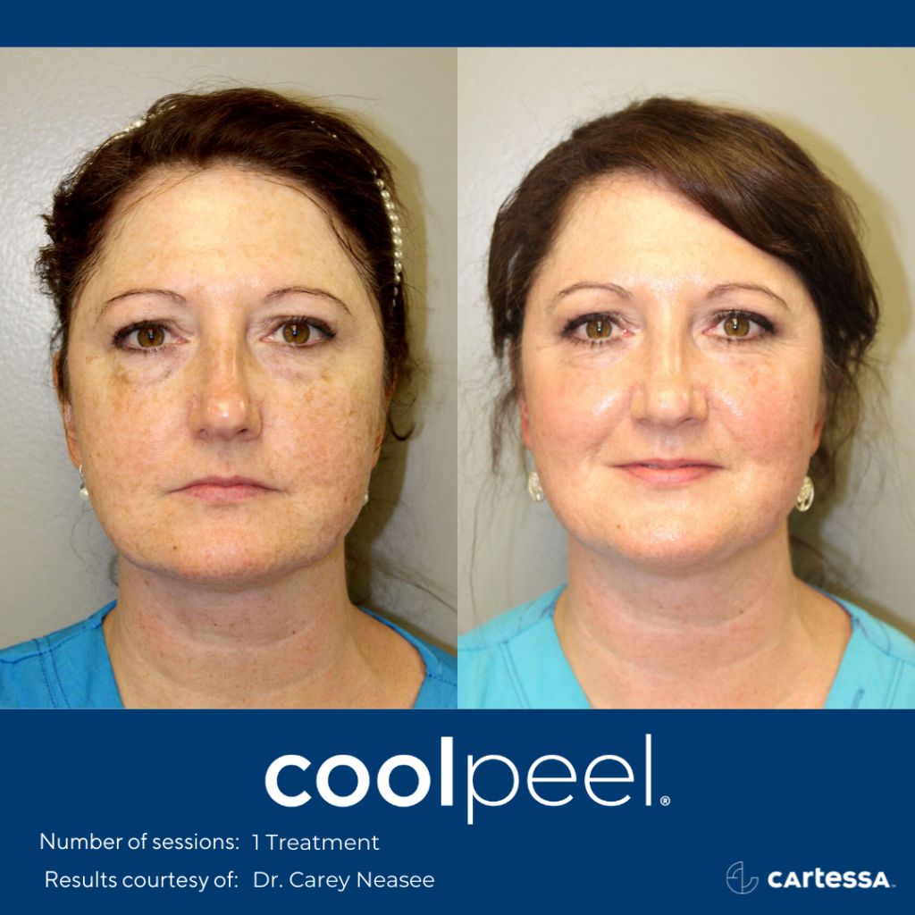 before and after CoolPeel Laser Resurfacing treatment showing reduced wrinkles and texturing on a woman's face