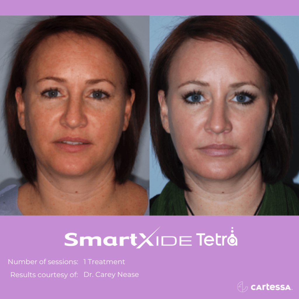 before and after Tetra CO2 laser resurfacing showing reduced wrinkles and texturing on middle aged women