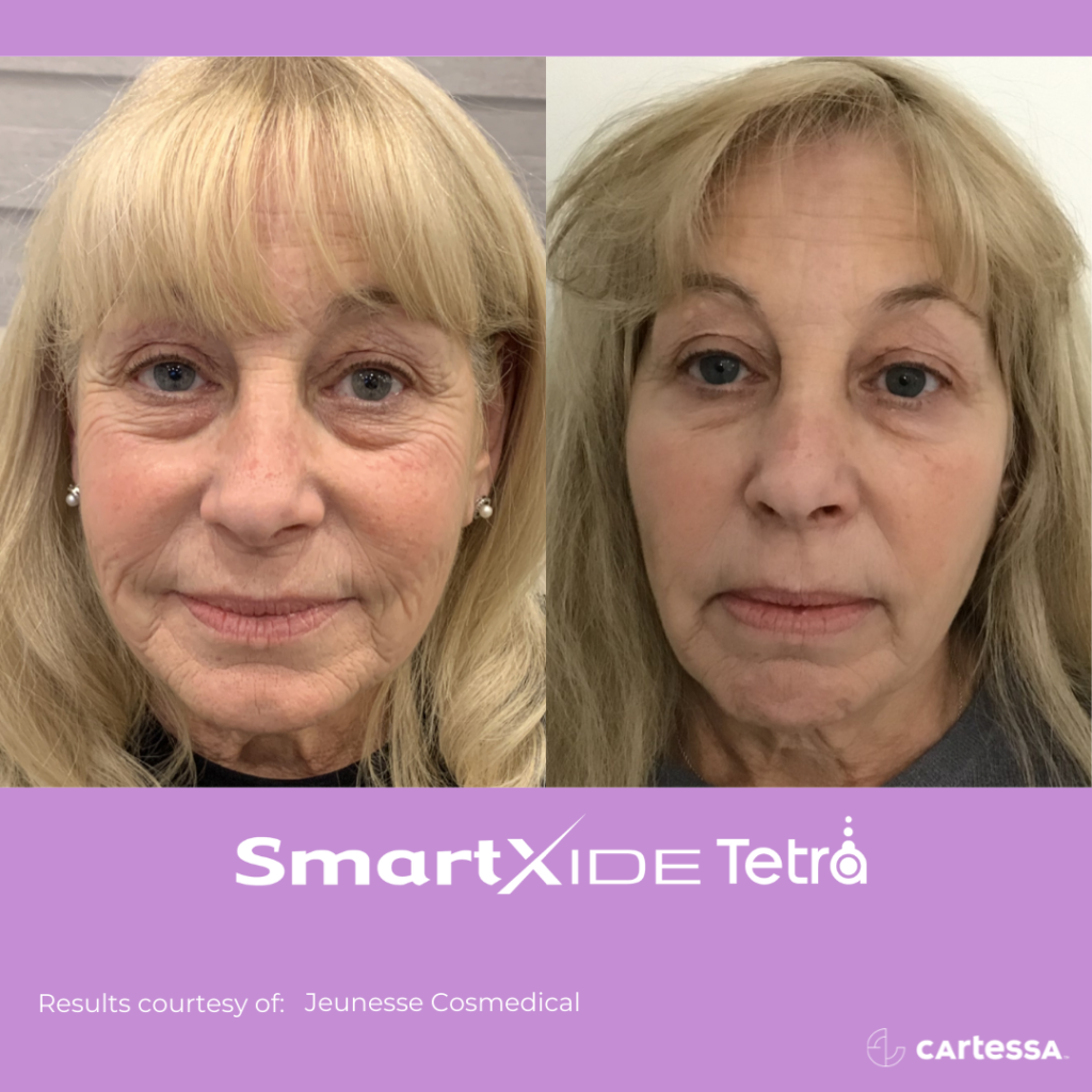 before and after Tetra CO2 laser resurfacing showing reduced wrinkles and texturing on middle aged women