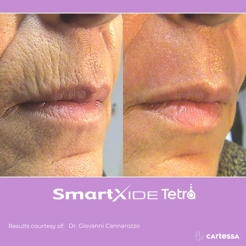 close-up around a woman's mouth before and after Tetra CO2 laser resurfacing showing reduced wrinkles