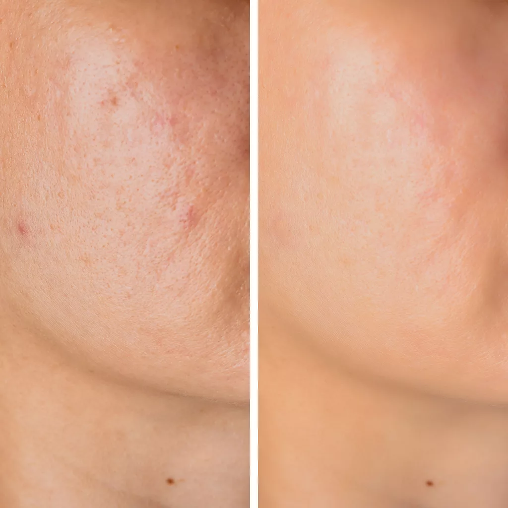 before and after CoolPeel laser resurfacing