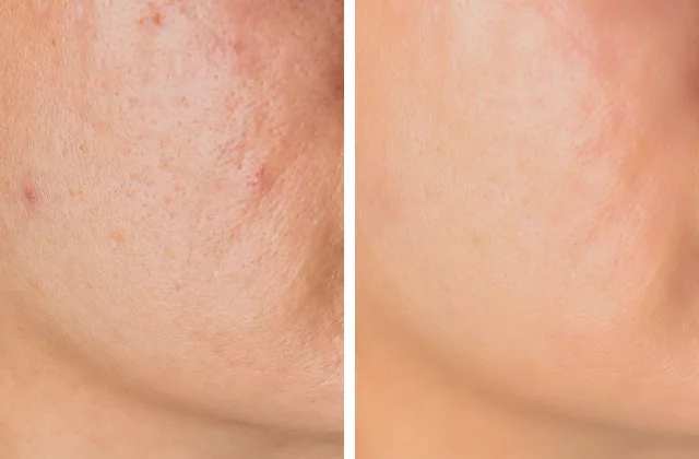 before and after CoolPeel laser resurfacing