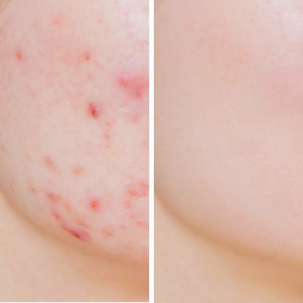 before and after fractional co2 laser resurfacing treatment