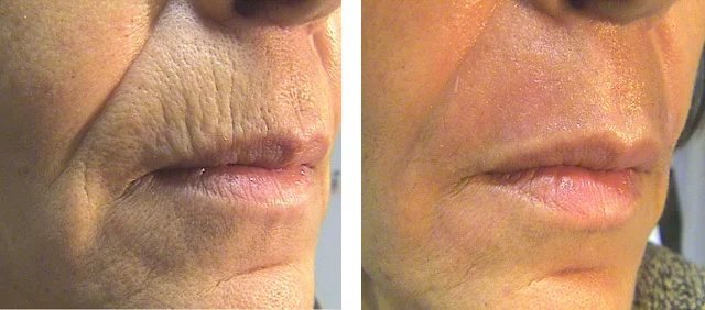 close-up view around a woman's mouth before and after Tetra CO2 Laser Resurfacing procedure