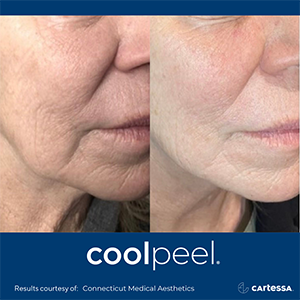 before and after CoolPeel laser skincare treatment at Artemedica Healdsburg showing reduced wrinkles and texturing on a woman's face