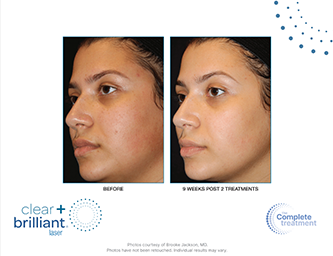 clear and brilliant touch laser skincare treatment at Artemedica Healdsburg before and after photo