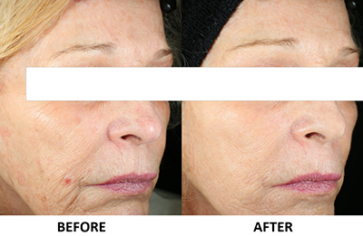 before and after vivace microneedling facial skincare treatment at Artemedica Healdsburg to revitalize your skin
