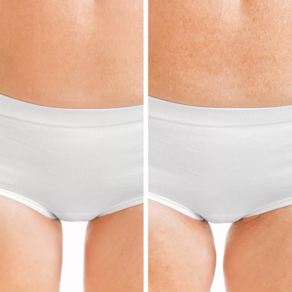 before and after emfemme 360 treatments for urinary incontinence and women's sexual wellness
