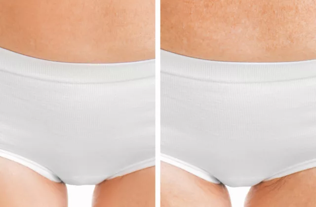before and after emfemme 360 treatments for urinary incontinence and women's sexual wellness