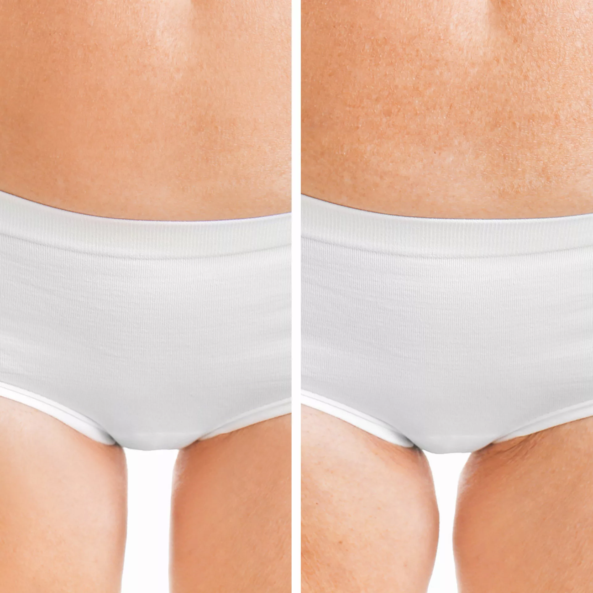 EMFEMME 360 - Vaginal Rejuvenation - Santa Rosa