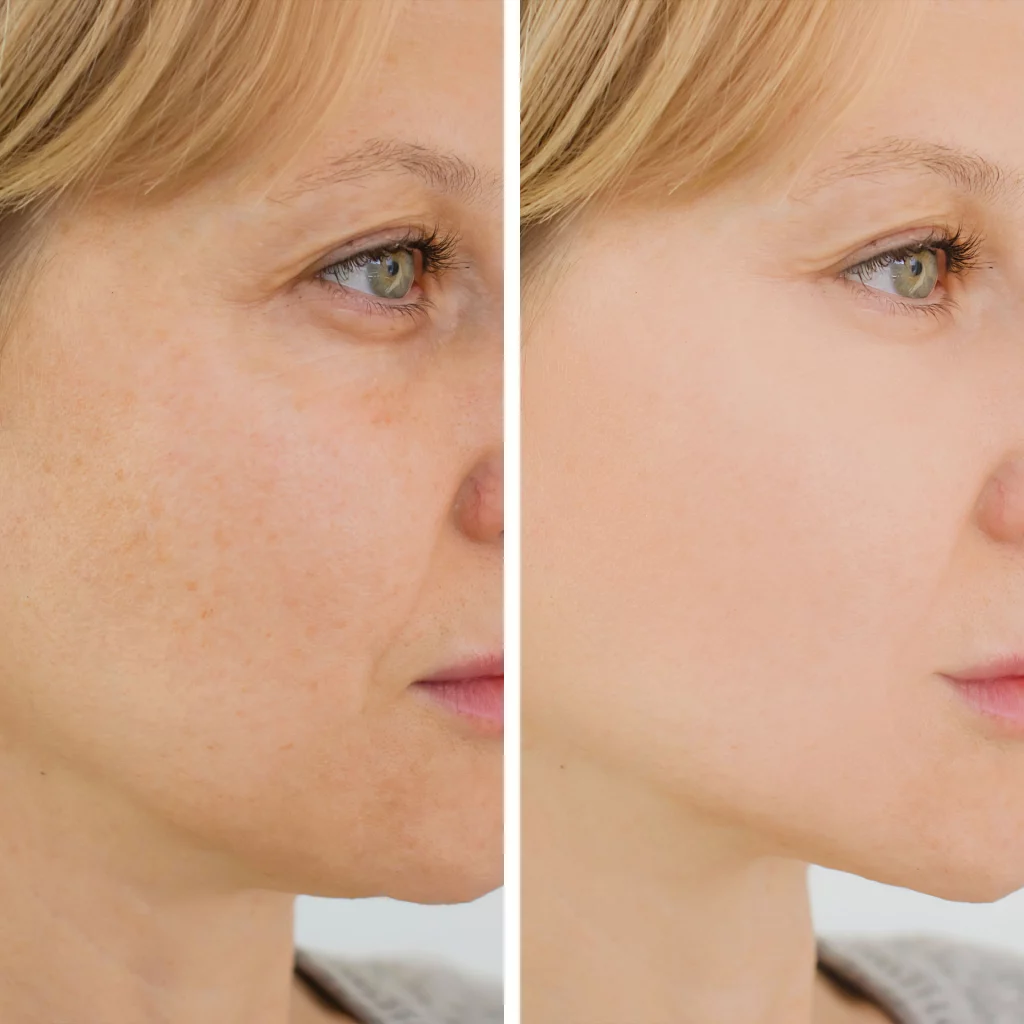 before and after juvederm volux xc injectable fillers