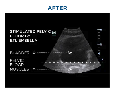 EMSELLA Before and After Treatment - After