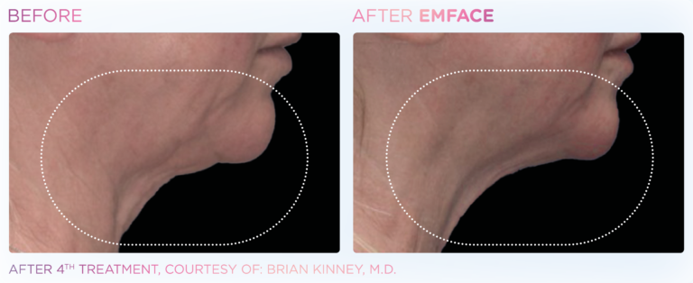 emface before and after female under chin and jawline