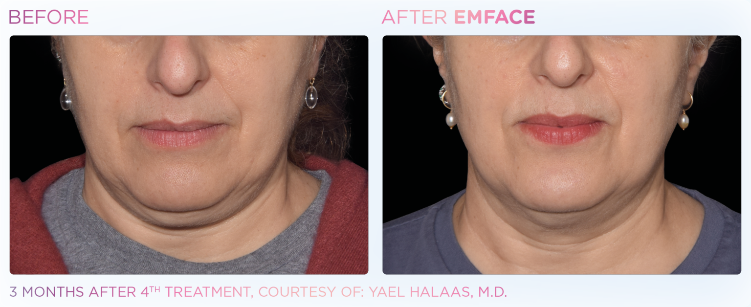 EmFace NonInvasive Facelift in Santa Rosa and Healdsburg