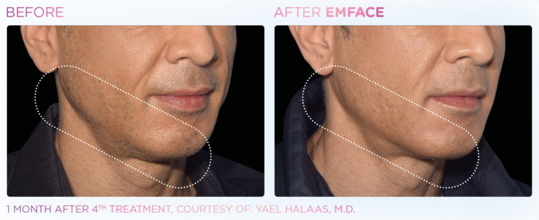 emface before and after male jawline