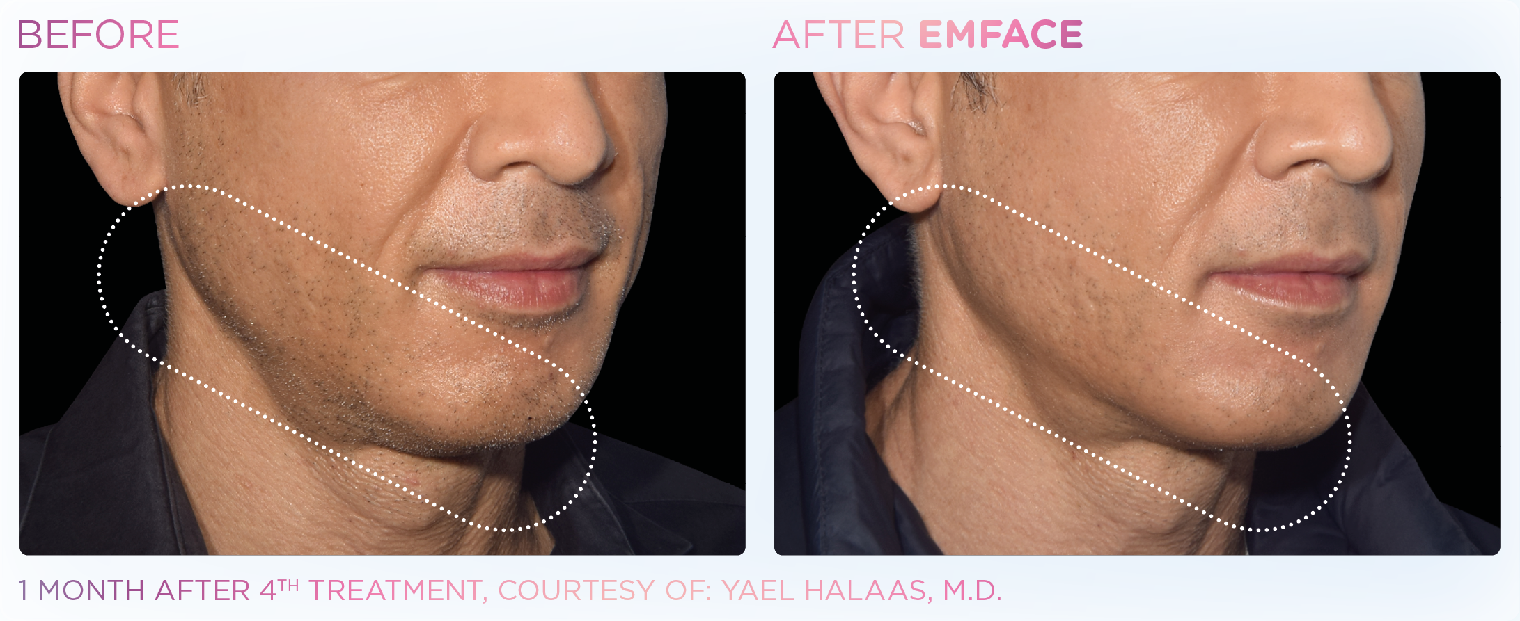 emface before and after male jawline