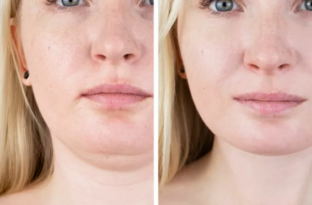 before and after emface to reduce fat in the face and enhance jaw contour