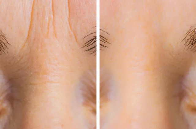 before and after DAXXIFY injections to address wrinkles between the eyebrows